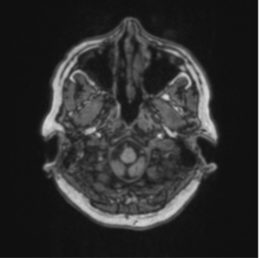 Cerebral abscess from pulmonary arteriovenous malformation (Radiopaedia 86275-102291 Axial T1 11).png