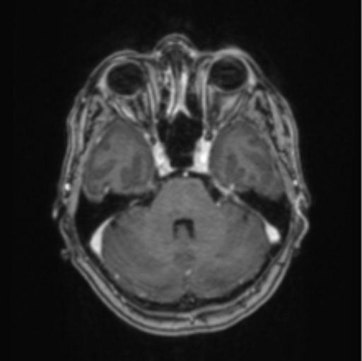 Cerebral abscess from pulmonary arteriovenous malformation (Radiopaedia 86275-102291 Axial T1 C+ 24).png