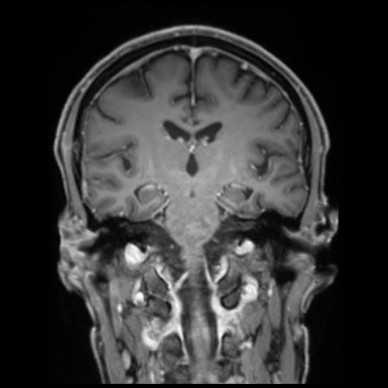 Cerebral abscess with ventriculitis (Radiopaedia 78965-91878 Coronal T1 C+ 35).jpg