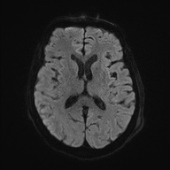 Cerebral amyloid angiopathy-related inflammation (Radiopaedia 74836-85849 Axial DWI 47).jpg