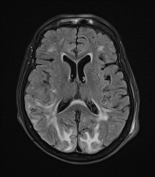 File:Cerebral amyloid angiopathy-related inflammation (Radiopaedia 74836-85849 Axial FLAIR 17).jpg