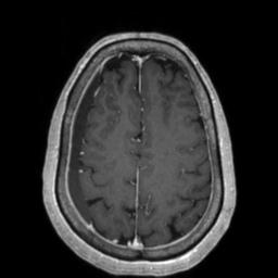 Cerebral amyloid angiopathy (Radiopaedia 29129-29518 Axial T1 C+ 113).jpg