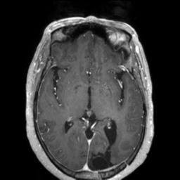 Cerebral amyloid angiopathy (Radiopaedia 29129-29518 Axial T1 C+ 73).jpg