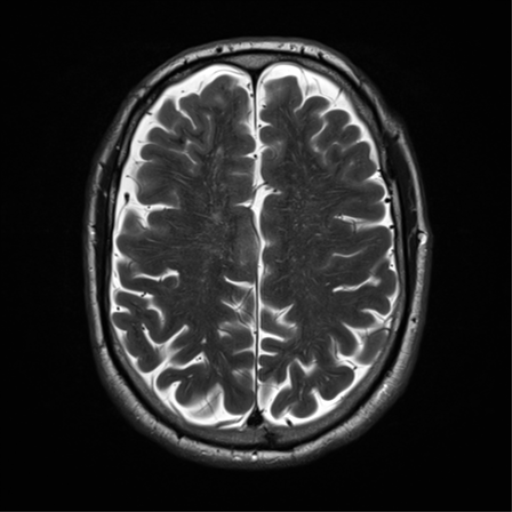 File:Cerebral amyloid angiopathy (Radiopaedia 46082-50433 Axial T2 26).png