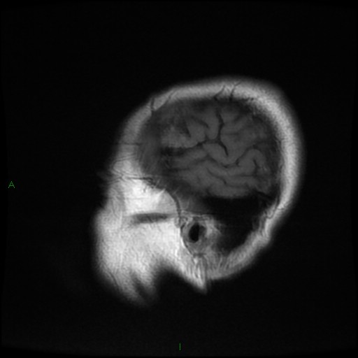 File:Cerebral amyloid angiopathy (Radiopaedia 77506-89664 Coronal T1 3).jpg
