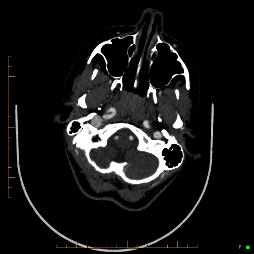 Cerebral arteriovenous malformation (AVM) (Radiopaedia 78162-90706 Axial CTA 52).jpg