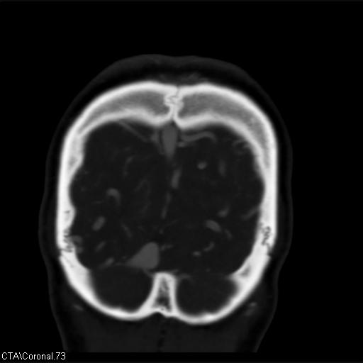 Cerebral arteriovenous malformation (Radiopaedia 28518-28759 C 73).jpg