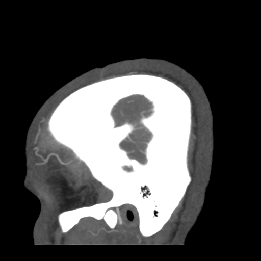 Cerebral arteriovenous malformation (Radiopaedia 39259-41505 Sagittal 7).png