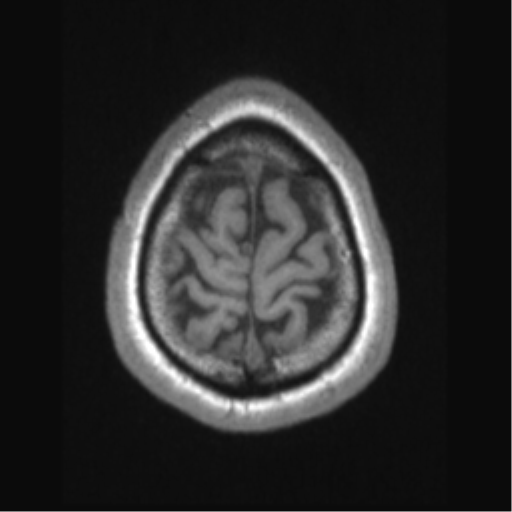 Cerebral arteriovenous malformation (Radiopaedia 39259-41506 Axial T1 70).png