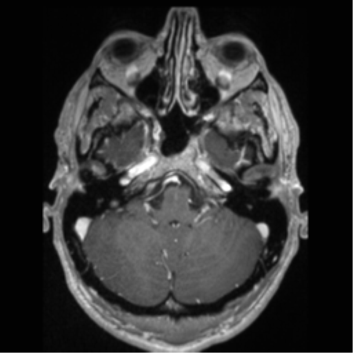 Cerebral arteriovenous malformation (Radiopaedia 55798-62372 Axial T1 C+ 15).png