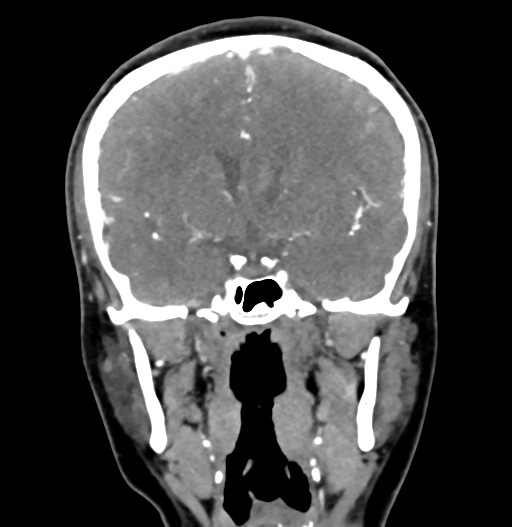 Cerebral arteriovenous malformation (Radiopaedia 73830-84645 C 45).jpg
