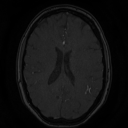 Cerebral arteriovenous malformation (Radiopaedia 74411-85654 Axial MRA 96).jpg