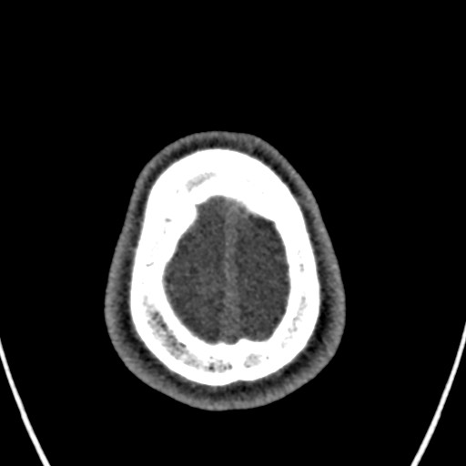 Cerebral arteriovenous malformation (Radiopaedia 78188-90746 Axial non-contrast 168).jpg
