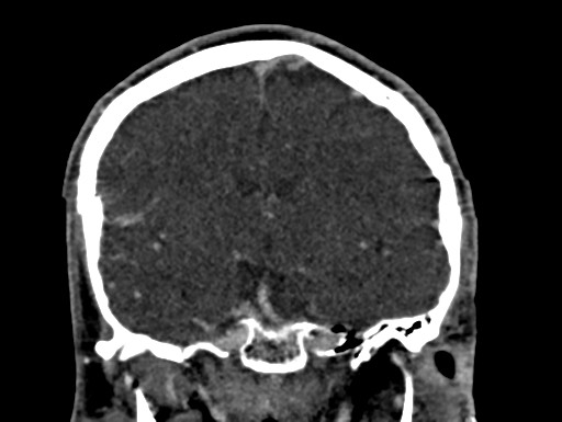 Cerebral arteriovenous malformation (Radiopaedia 78188-90746 Coronal C+ delayed 56).jpg