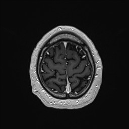 Cerebral arteriovenous malformation (Radiopaedia 84015-99245 Axial T1 C+ 136).jpg