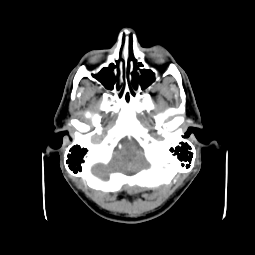 Cerebral arteriovenous malformation (Spetzler-Martin grade 2) (Radiopaedia 41262-44076 Axial C+ 7).png