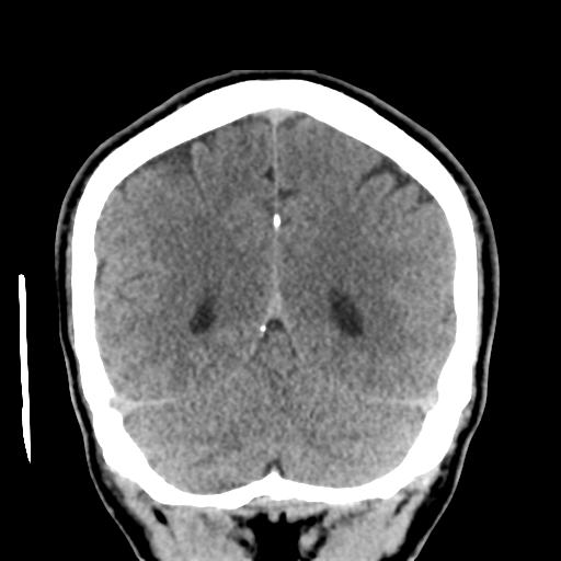 File:Cerebral arteriovenous malformation (Spetzler-Martin grade 2) (Radiopaedia 41262-44076 Coronal non-contrast 48).png