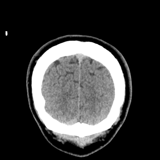 Cerebral arteriovenous malformation (Spetzler-Martin grade 2) (Radiopaedia 41262-44076 Coronal non-contrast 59).png