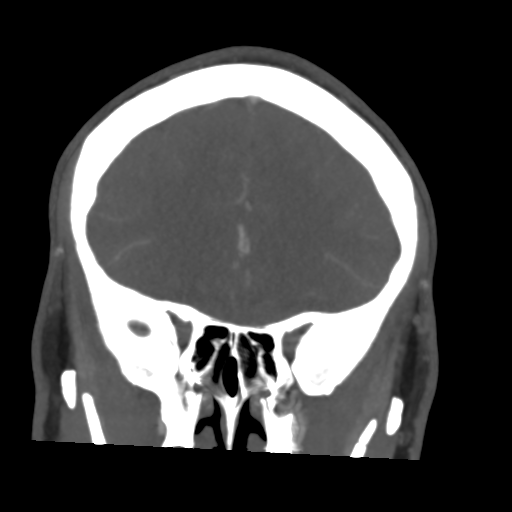 Cerebral arteriovenous malformation (Spetzler-Martin grade 2) (Radiopaedia 41262-44076 F 19).png