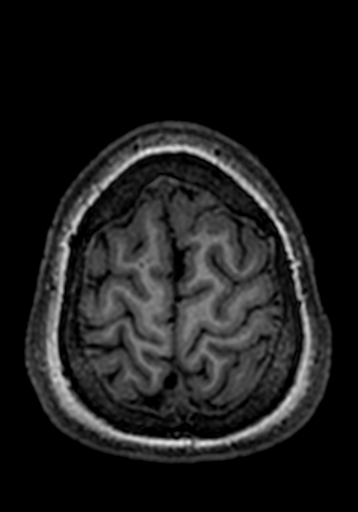 Cerebral arteriovenous malformation at posterior body of corpus callosum (Radiopaedia 74111-84925 Axial T1 21).jpg