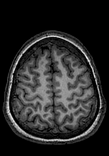 File:Cerebral arteriovenous malformation at posterior body of corpus callosum (Radiopaedia 74111-84925 Axial T1 46).jpg