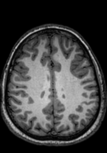 File:Cerebral arteriovenous malformation at posterior body of corpus callosum (Radiopaedia 74111-84925 Axial T1 84).jpg