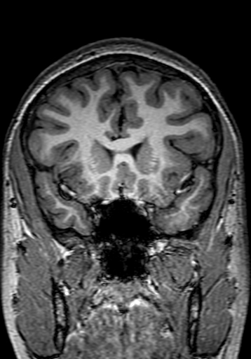 Cerebral arteriovenous malformation at posterior body of corpus callosum (Radiopaedia 74111-84925 Coronal T1 100).jpg