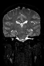 Cerebral arteriovenous malformation at posterior body of corpus callosum (Radiopaedia 74111-84925 Coronal T2 100).jpg