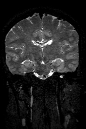 Cerebral arteriovenous malformation at posterior body of corpus callosum (Radiopaedia 74111-84925 Coronal T2 94).jpg