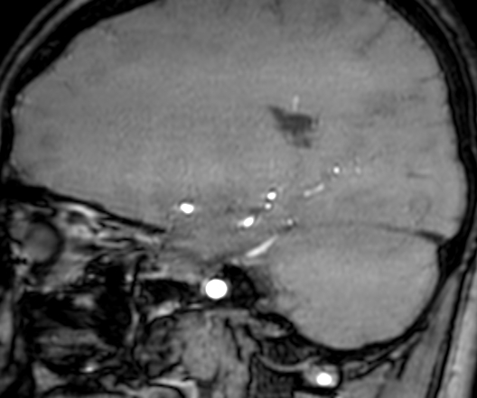 Cerebral arteriovenous malformation at posterior body of corpus callosum (Radiopaedia 74111-84925 J 137).jpg