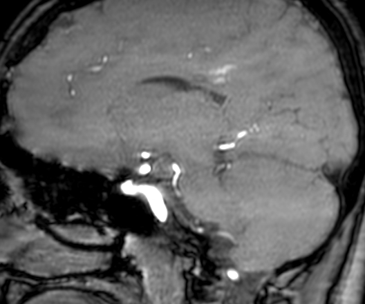Cerebral arteriovenous malformation at posterior body of corpus callosum (Radiopaedia 74111-84925 J 161).jpg