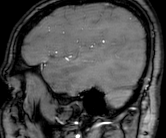 File:Cerebral arteriovenous malformation at posterior body of corpus callosum (Radiopaedia 74111-84925 J 54).jpg