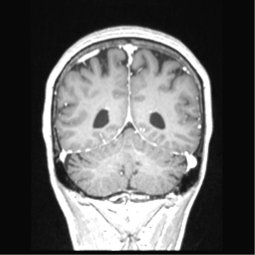 Cerebral arteriovenous malformation with hemorrhage (Radiopaedia 34422-35737 Coronal T1 C+ 28).png