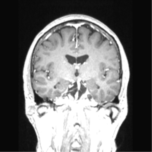 Cerebral arteriovenous malformation with hemorrhage (Radiopaedia 34422-35737 Coronal T1 C+ 50).png