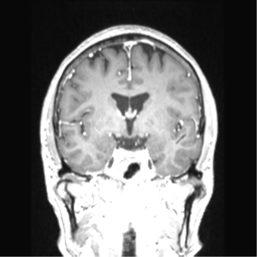 Cerebral arteriovenous malformation with hemorrhage (Radiopaedia 34422-35737 Coronal T1 C+ 53).png