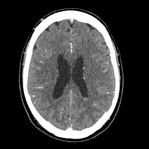 Cerebral arteriovenous malformation with lobar hemorrhage (Radiopaedia 35598-57216 A 39).jpg