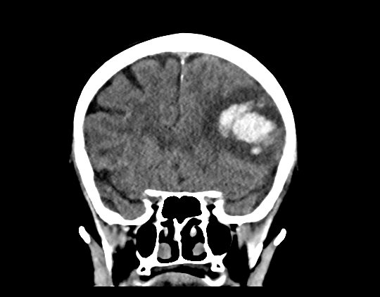Cerebral arteriovenous malformation with lobar hemorrhage (Radiopaedia 44725-48510 Coronal non-contrast 19).png