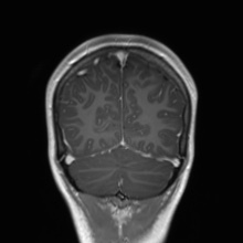 File:Cerebral cavernous venous malformation (Radiopaedia 70008-80021 Coronal T1 C+ 14).jpg