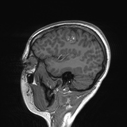 File:Cerebral cavernous venous malformation (Radiopaedia 70008-80021 Sagittal T1 17).jpg