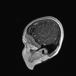 Cerebral cavernous venous malformation (Radiopaedia 70008-80021 Sagittal T1 C+ 65).jpg