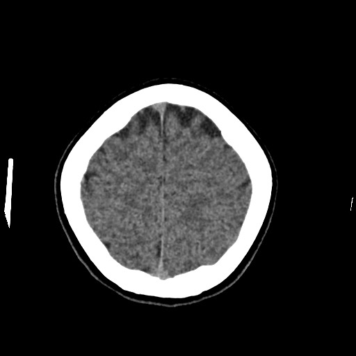 Cerebral cavernous venous malformation (Radiopaedia 70008-80022 Axial non-contrast 45).jpg