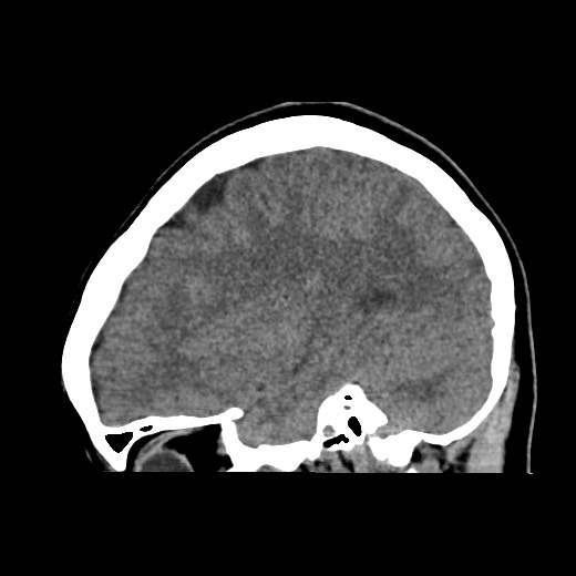 File:Cerebral cavernous venous malformation (Radiopaedia 70008-80022 C 40).jpg