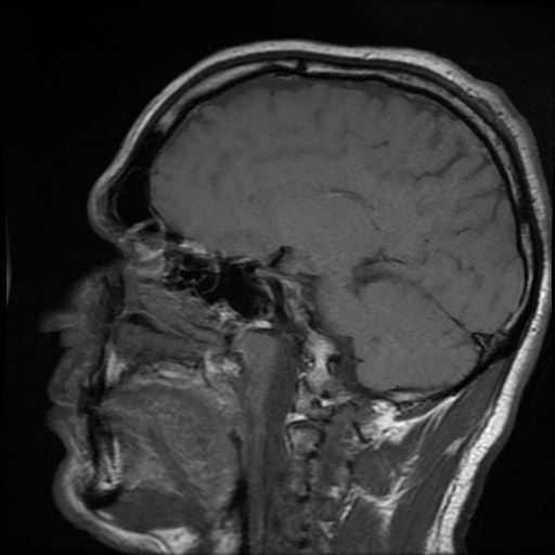 File:Cerebral cavernous venous malformation (Zabramski type II) (Radiopaedia 85511-101198 Sagittal T1 16).jpg