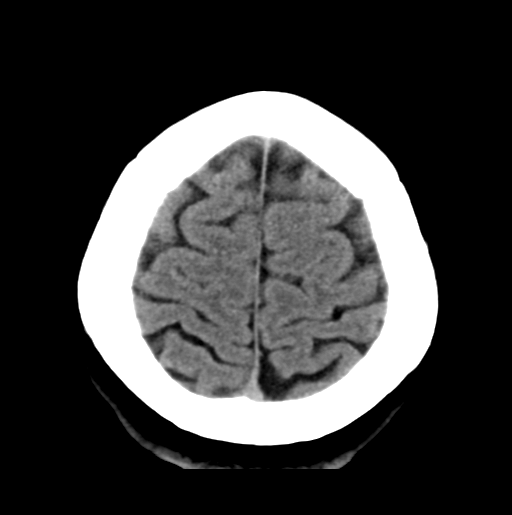 File:Cerebral cavernous venous malformations (Radiopaedia 48117-52945 Axial non-contrast 28).png
