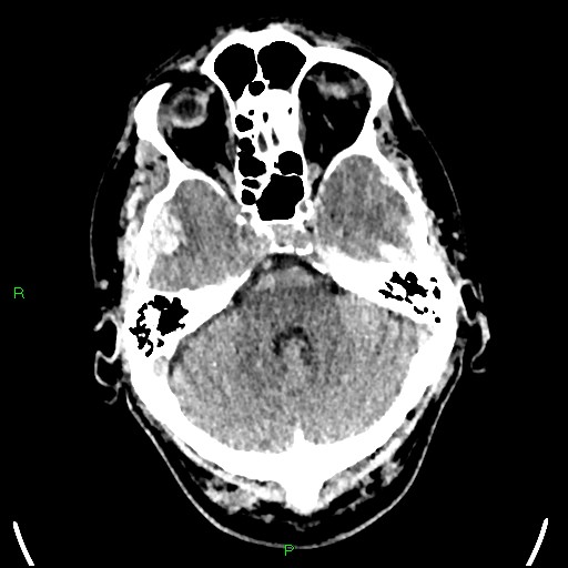 File:Cerebral contusions (Radiopaedia 33868-35039 Axial non-contrast 55).jpg