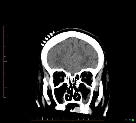 Cerebral fat embolism (Radiopaedia 85521-101220 Coronal non-contrast 16).jpg