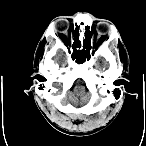 File:Cerebral hemorrhagic contusions- temporal evolution (Radiopaedia 40224-42754 Axial non-contrast 3).png