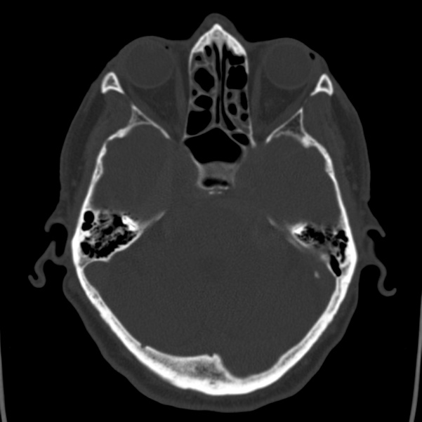 Cerebral hemorrhagic contusions (Radiopaedia 23145-23188 Axial bone window 16).jpg