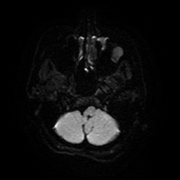 Cerebral metastases - melanoma (Radiopaedia 80972-94522 Axial DWI 6).jpg