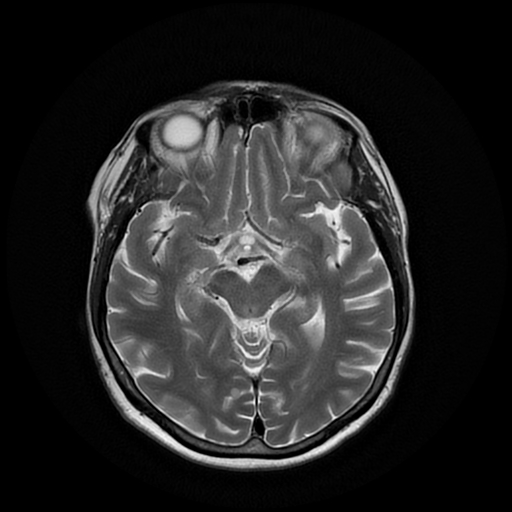 File:Cerebral metastases - melanoma (Radiopaedia 80972-94522 Axial T2 14).jpg